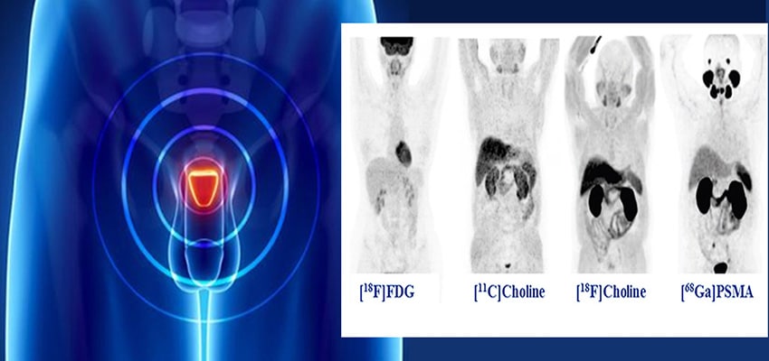 اسکن PSMA پروستات
