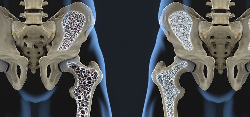 پوکی استخوان