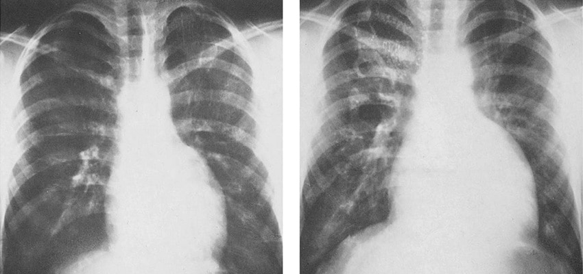 سی تی اسکن قلب